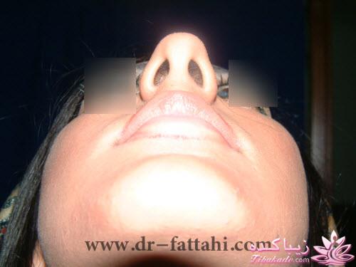 جراحی بینی - جراحی زیبایی